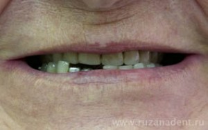 Photo: dents avant prothèses