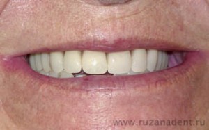 Photo: dents après prothèses