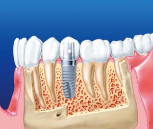 Photo: implant dans l'os de la mâchoire inférieure