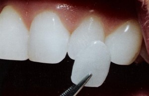 Photo: fixation du placage à une couronne dentaire