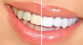 Photo: Dents avant et après l'installation des lumineers