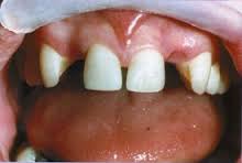 Photo: défauts de la dentition