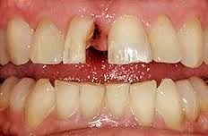 Photo: Lésion de la dent et de sa partie sous-gingivale