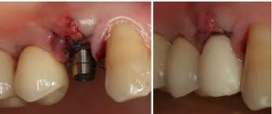 Photo: implantation après extraction dentaire