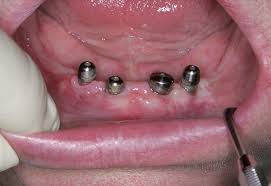 Photo: implantation en l'absence de plusieurs dents