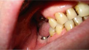 Photo: Avoir des dents saines près de l'implant