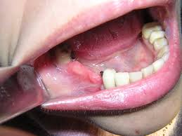 Photo: Manque de dents - une indication pour les prothèses de voûte plantaire