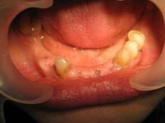 Photo: défauts de la dentition
