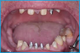 Photo: dents préparées