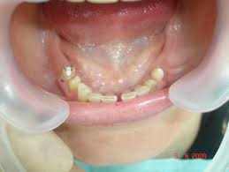 Photo: Manque partiel de dents