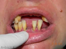 Photo: La présence de défauts dans la dentition, relâchement des dents