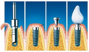 Photo: étapes de la pose de l'implant