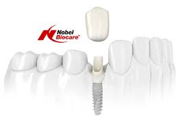 Photo: implants Nobel Biocare