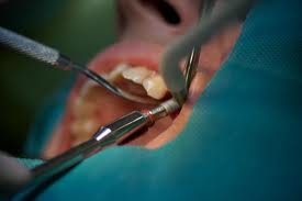 Photo: implantation dentaire