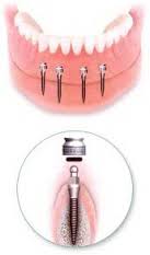 Photo: Prothèses sur mini-implants