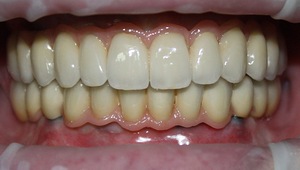 Photo: Restauration complète des dents
