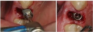 Photo: placement de l'implant après extraction dentaire