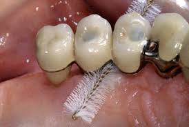 Photo: soins des implants dentaires