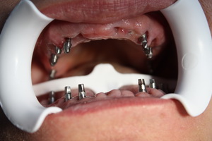 Photo: implantation basale avec absence totale de dents