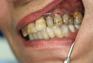 Photo: L'effet du tabagisme sur la santé dentaire et buccale