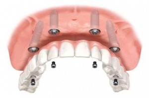 Photo: Implants dentaires en une journée