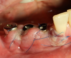 Photo: œdème dans le domaine des implants installés