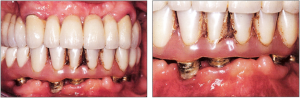 Photo: Plaque sur implants et dents artificielles