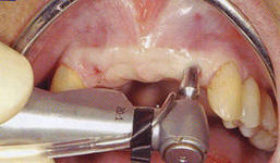 Photo: implantation endoscopique