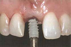 Photo: placement de l'implant après extraction dentaire