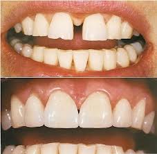 Photo: Les placages ont couvert l'espace entre les dents