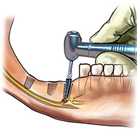 Photo: Dommages au nerf mandibulaire pendant la chirurgie