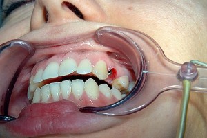 Photo: implantation immédiatement après l'extraction dentaire