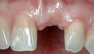 Photo: Absence d'une dent antérieure dans la mâchoire supérieure - indication d'implantation