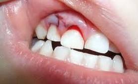 PHOTO: blessure à la dent