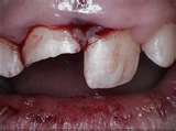 Photo: blessure à la dent