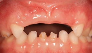 Photo: Manque de dents primaires frontales
