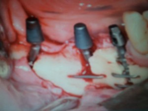 Photo: Implants BOI installés dans la mâchoire inférieure