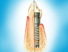Implantation dentaire