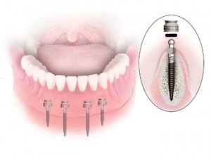 Photo: Implant dentaire exsangue