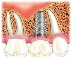 Photo: Implants dentaires