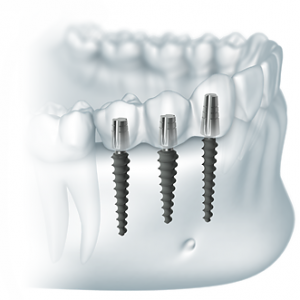 Photo: Implants insérés à travers une ponction gingivale