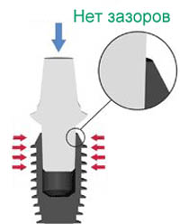 Photo: Connexion d'un implant avec un pilier