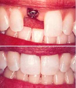 Photo: Similitude entre l'implant et la dent naturelle