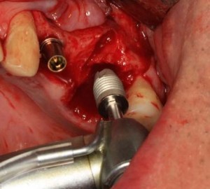 Photo: Insertion d'un implant dans un trou après extraction dentaire