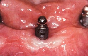 Falto: Inflammation des gencives autour de l'implant