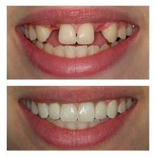 Photo: Avant et après les implants dentaires