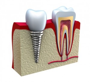 Photo: implant dentaire à la place d'une dent manquante
