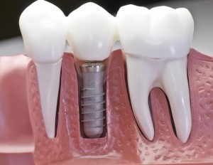 Photo: implant dentaire en forme de racine