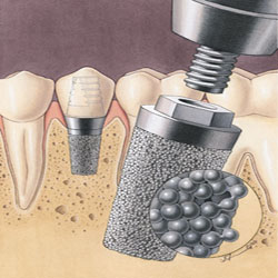 Photo: Surface d'implant rugueuse