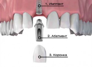 Photo: Structure de l'implant